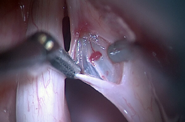 vocal surgery 01